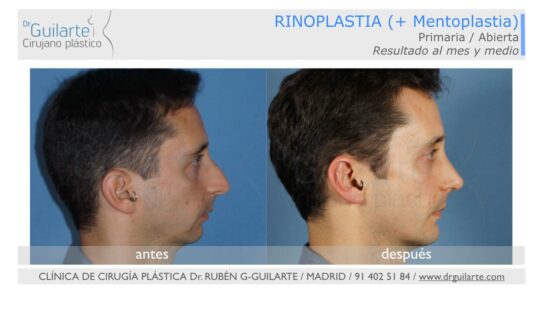 Mejor Cirujano Rinoplastia Mentoplastia Madrid Foto Antes Despues Buen