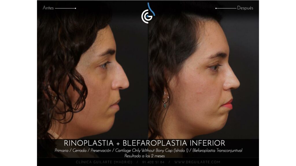 Caso Foto Rinoplastia Drguilarte